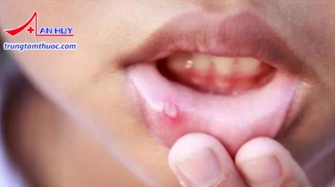 Hình ảnh người bị nhiệt miệng