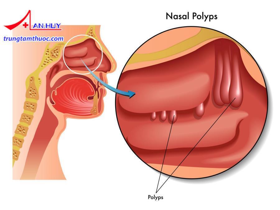 polyp_mui