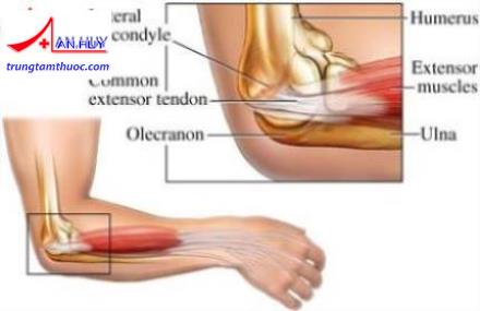 Viêm lồi cầu ngoài xương cánh tay