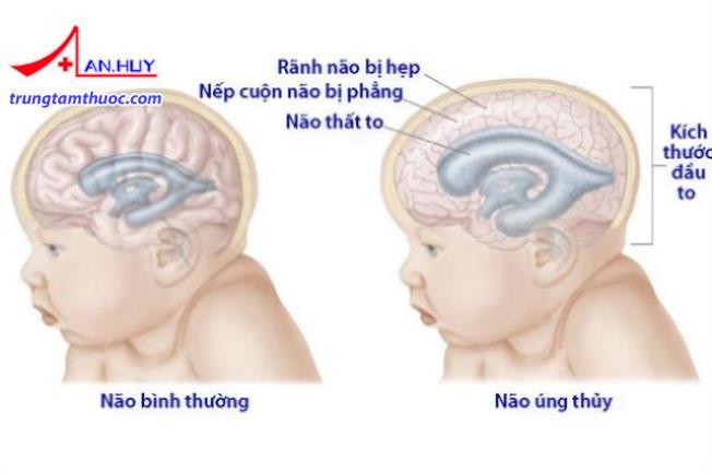 Não úng thủy là sự gia tăng của dịch não tủy trong sọ não.