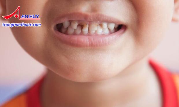 Hình ảnh minh họa: Răng sữa bị hoại tử tủy