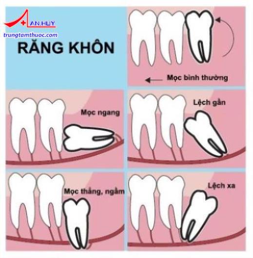 Các kiểu mọc của răng khôn