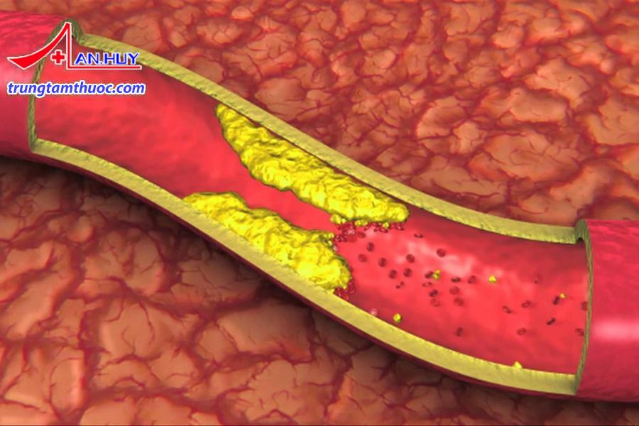 Triệu chứng của rối loạn lipid máu.