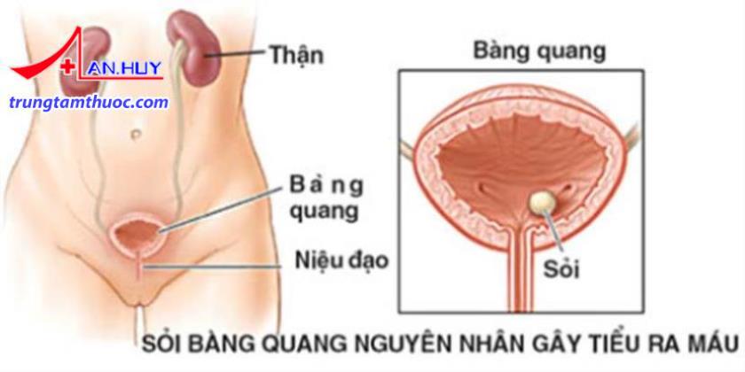 Sỏi bàng quang gây tiểu ra máu