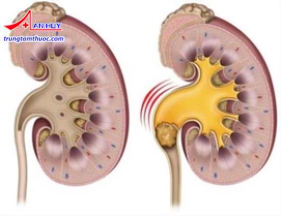 Hình ảnh thận bị sỏi