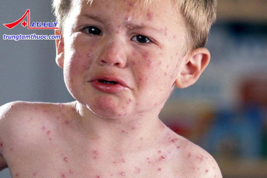 Trẻ bị sốt phát ban do hệ miễn dịch suy yếu.