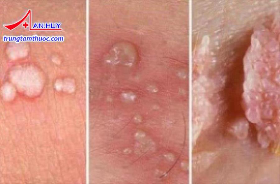 Bệnh sùi mào gà có triệu chứng như thế nào?