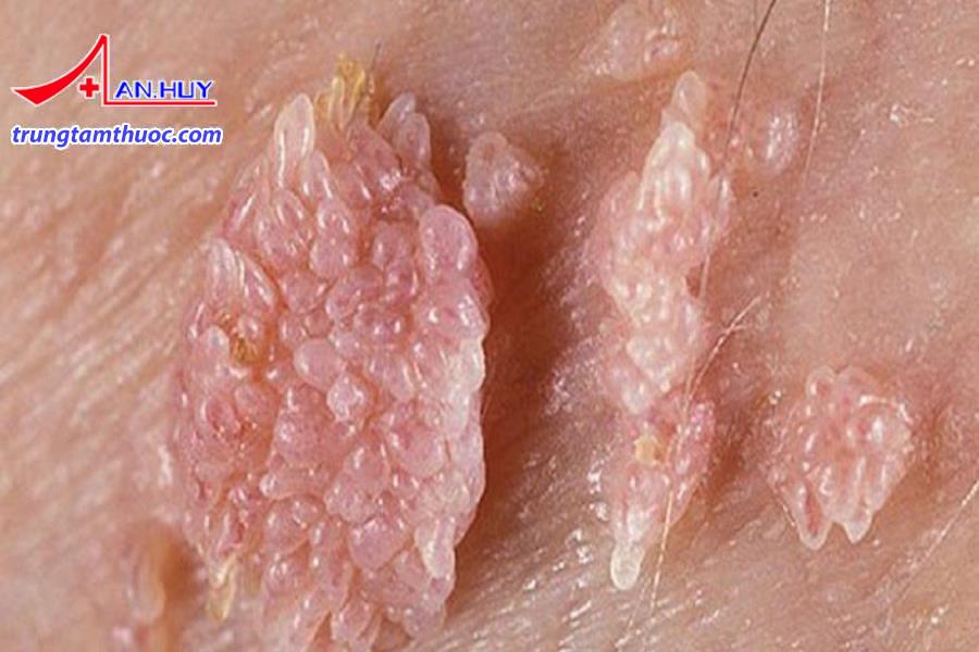 Phòng ngừa nhiễm sùi mào gà bằng cách quan hệ tình dục an toàn.