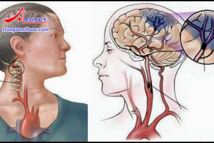 Tai biến mạch máu não có những triệu chứng như thế nào?