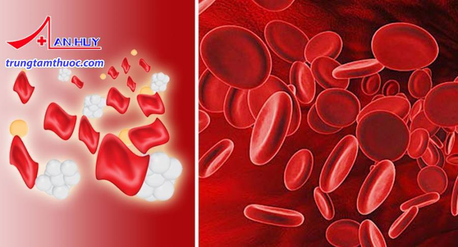 Tan máu tự miễn là bệnh gì?