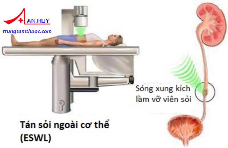 Tán sỏi ngoài cơ thể