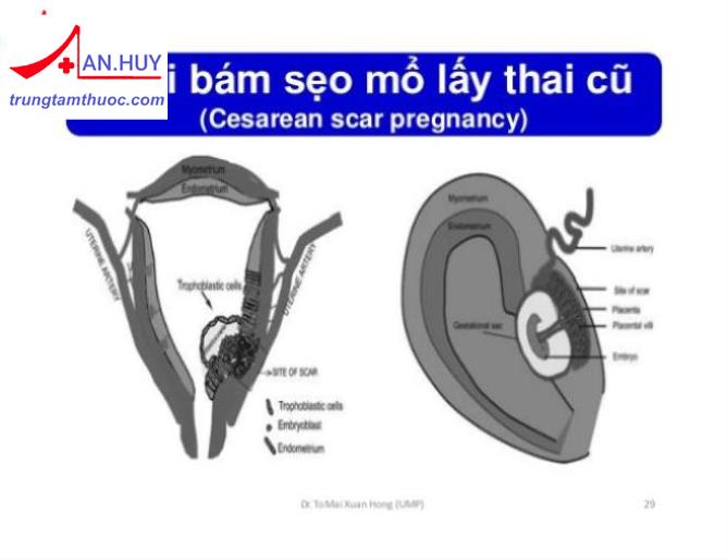 Thai ở sẹo mổ lấy thai