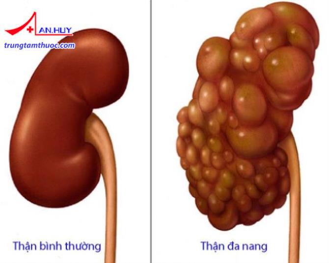 Hình ảnh thận đa nang