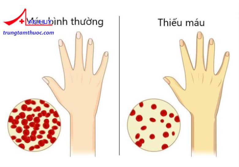 Tình trạng thiếu máu