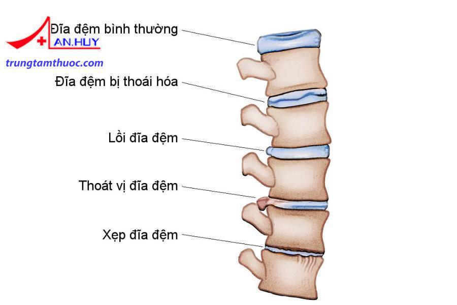 Chẩn đoán thoái hóa cột sống thắt lưng như thế nào?