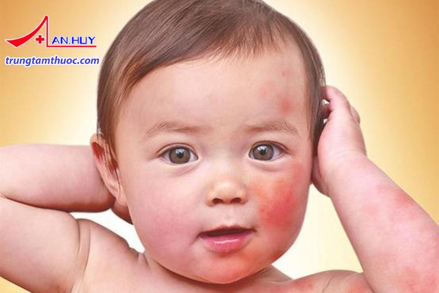 Trẻ bị dị ứng nổi mẩn đỏ.