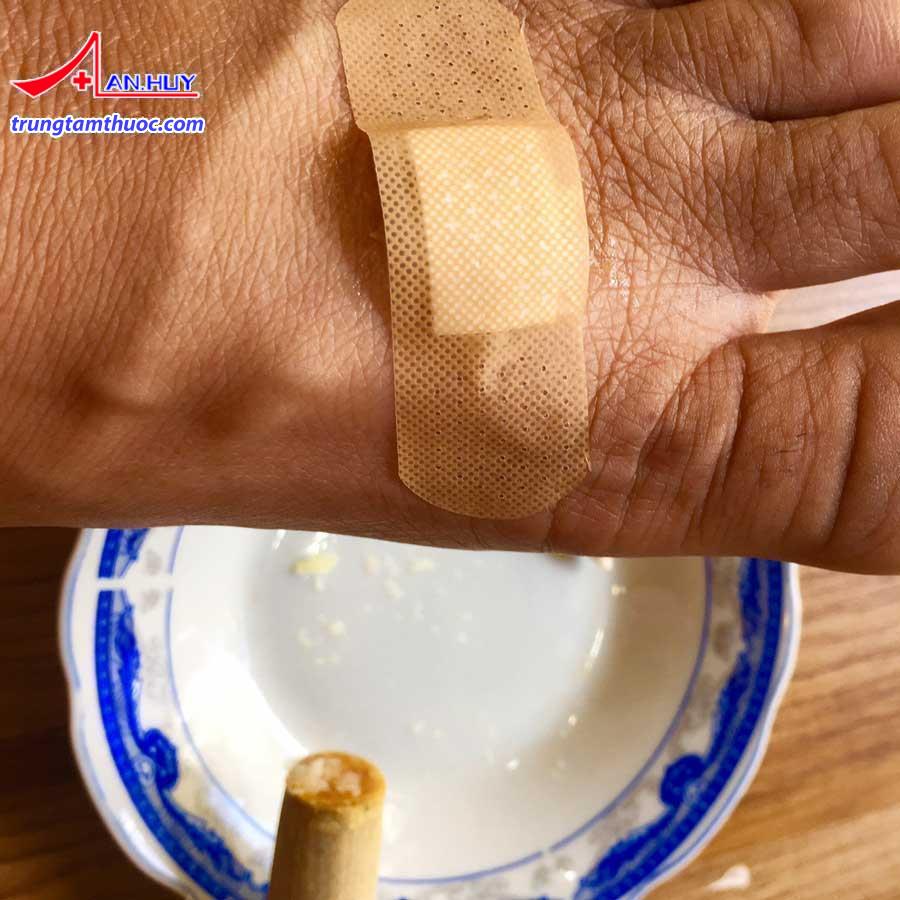 Trị mụn cóc tận gốc hiệu quả 100% từ tỏi tại nhà