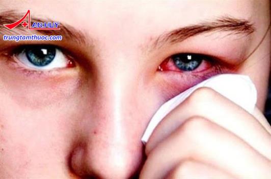 Triệu chứng viêm tổ chức hốc mắt