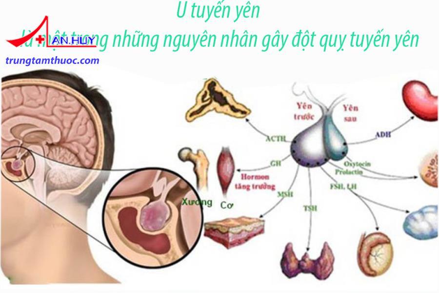 Nguyên nhân nào gây đột quỵ tuyến yên?