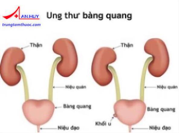 Ung thư bàng quang