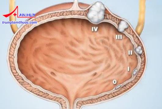Các giai đoạn ung thư bàng quang