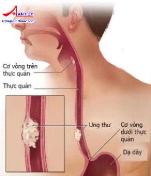Ung thư thực quản