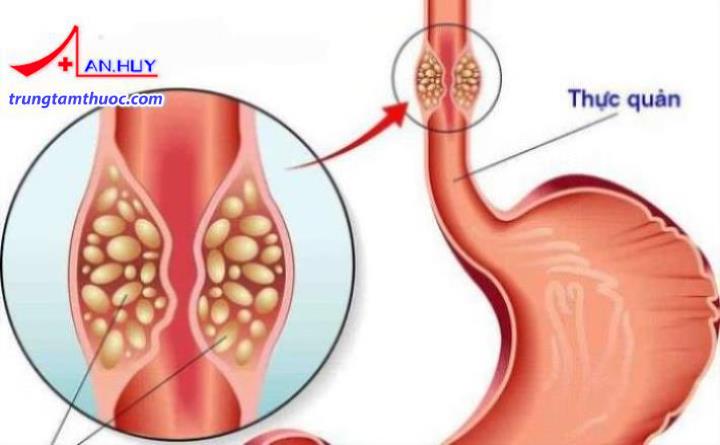 Triệu chứng của ung thư thực quản là gì?
