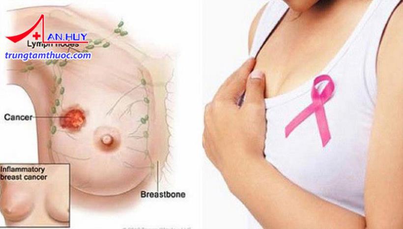 Ung thư vú là bệnh gì?