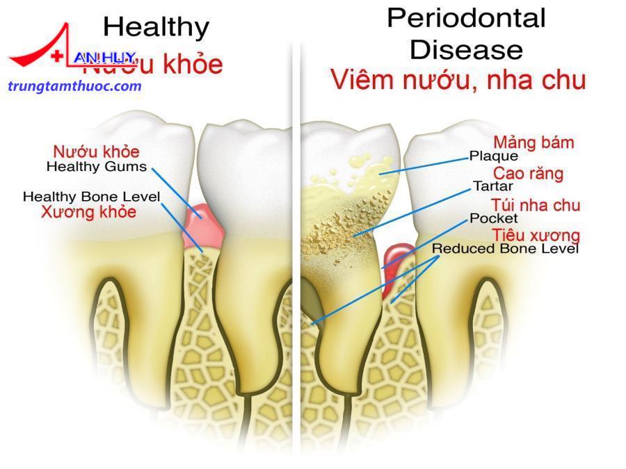 Viêm nha chu