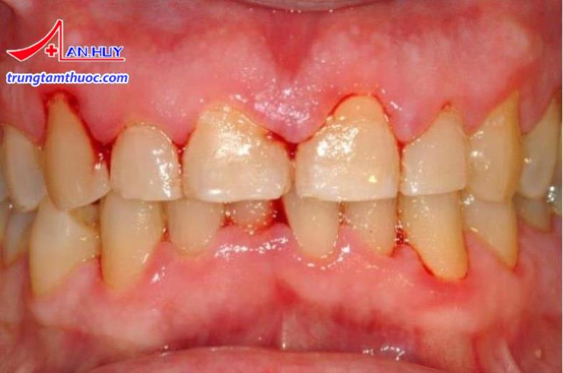 Viêm nướu triển dưỡng