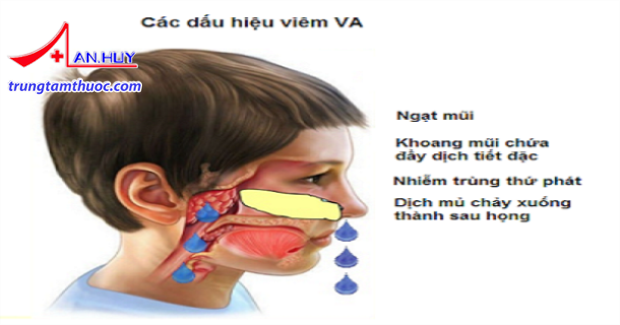 dau_hieu_viem_VA