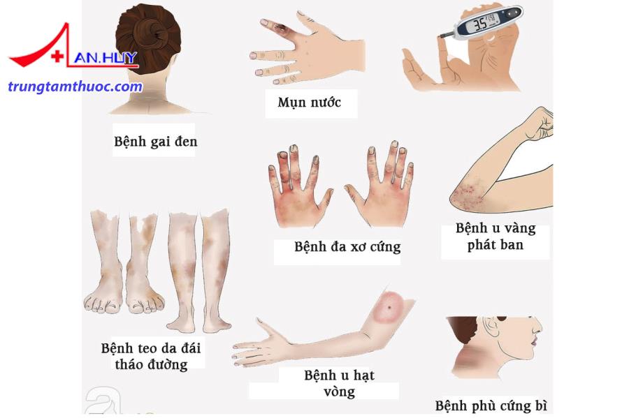 Bệnh lý viêm da của người bệnh đái tháo đường typ 1.