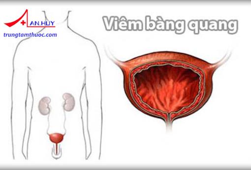 Hình ảnh minh họa: viêm bàng quang
