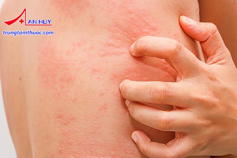 Điều trị và phòng ngừa viêm da tiếp xúc với côn trùng như thế nào?