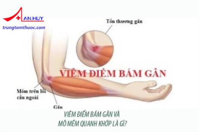 Viêm điểm bám gân và mô mềm quanh khớp là gì?