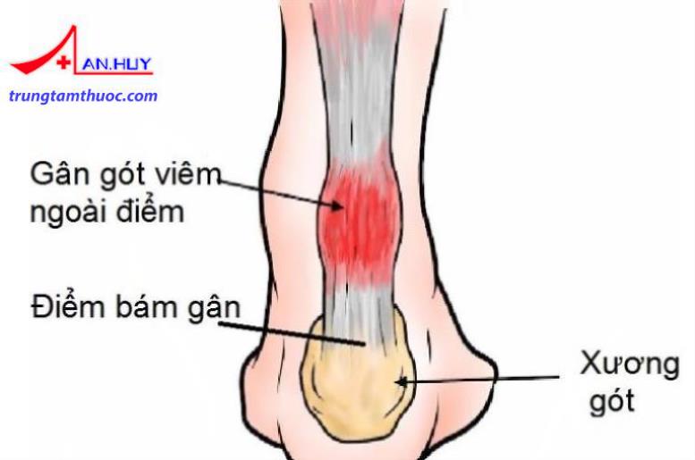Viêm điểm bám gân và mô mềm quanh khớp được chẩn đoán như thế nào?