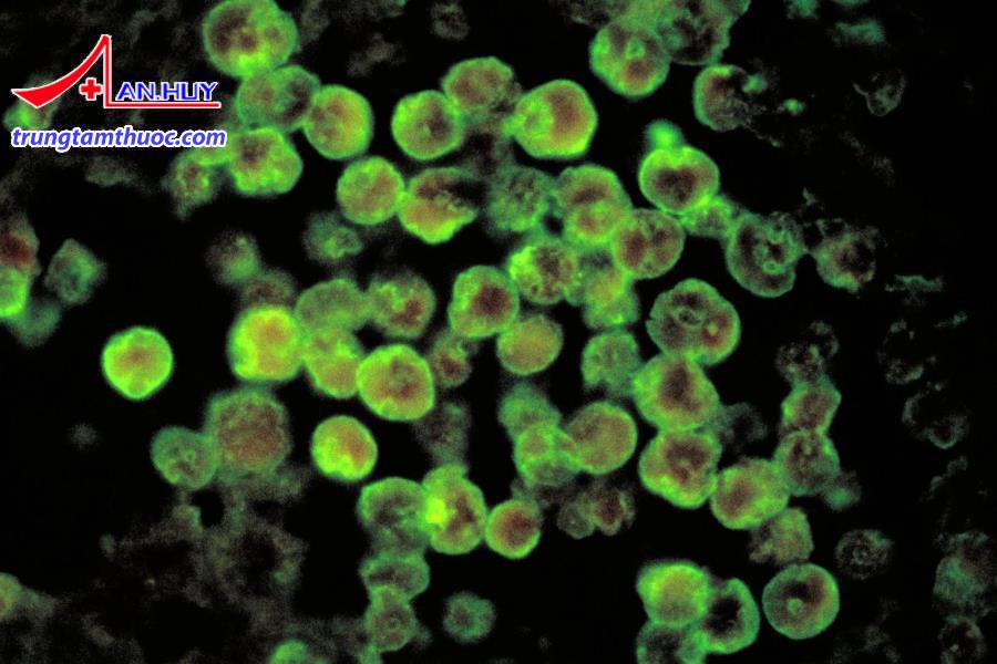 Viêm não màng não do đơn bào amip Naegleria fowleri.