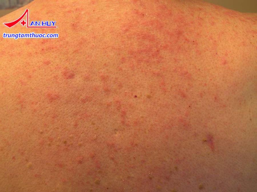 Các nang lông bị viêm tạo thành các mụn mủ viêm.