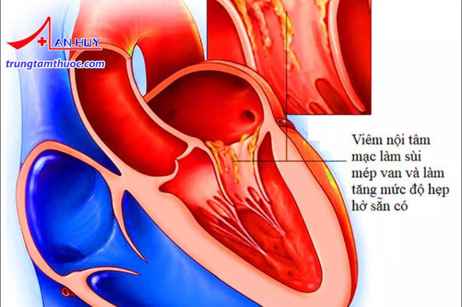 Viêm nội tâm mạc nhiễm khuẩn có triệu chứng gì?