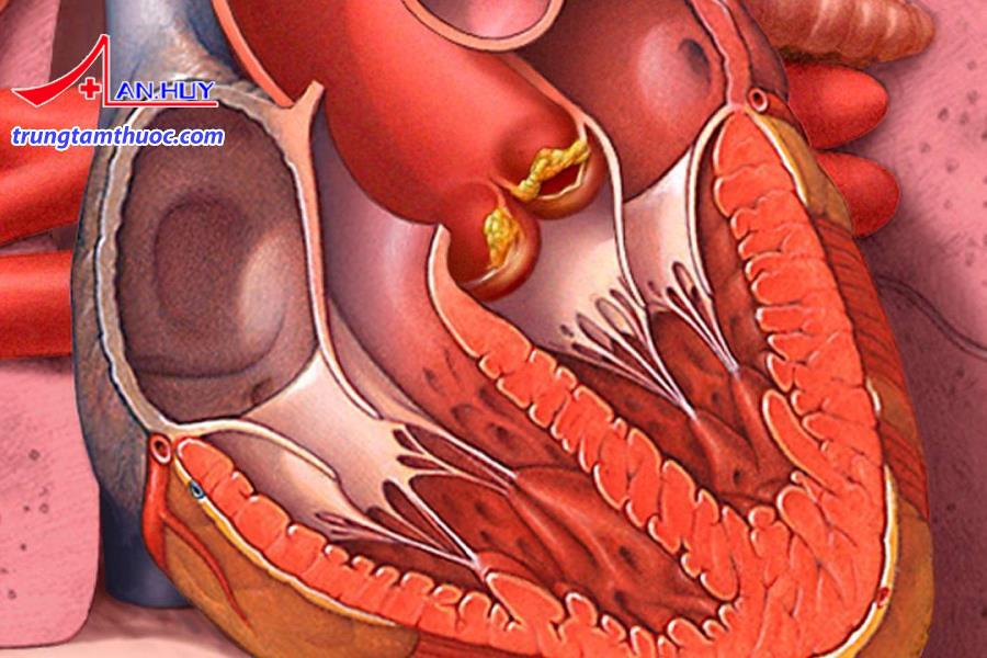 Điều trị viêm nội tâm mạc nhiễm khuẩn như thế nào?
