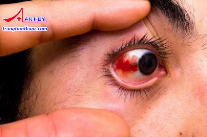 Xuất huyết nội nhãn sau chấn thương