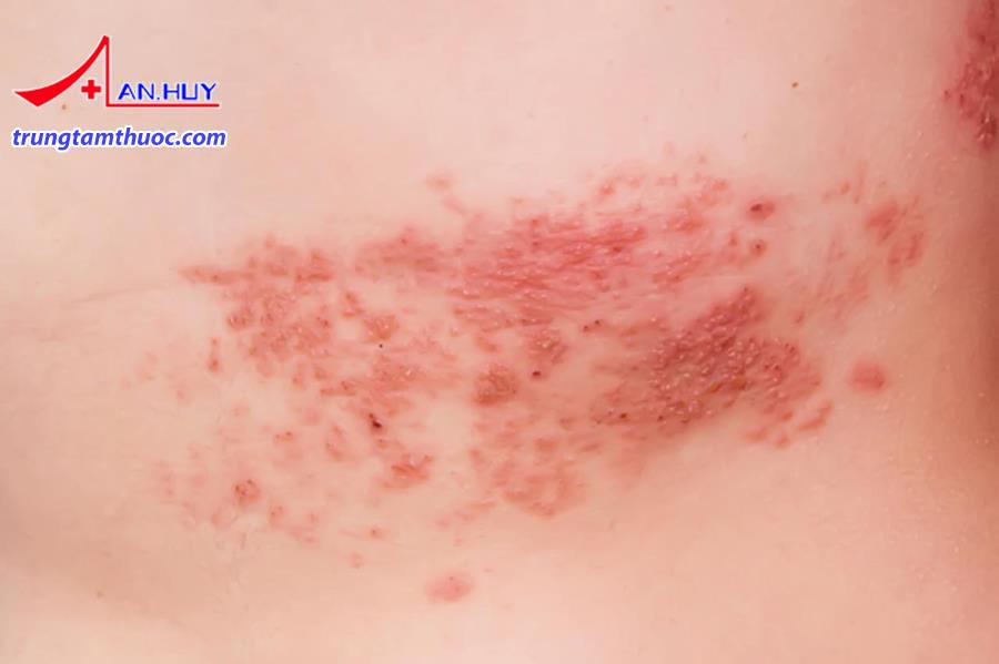 Bệnh zona là gì?