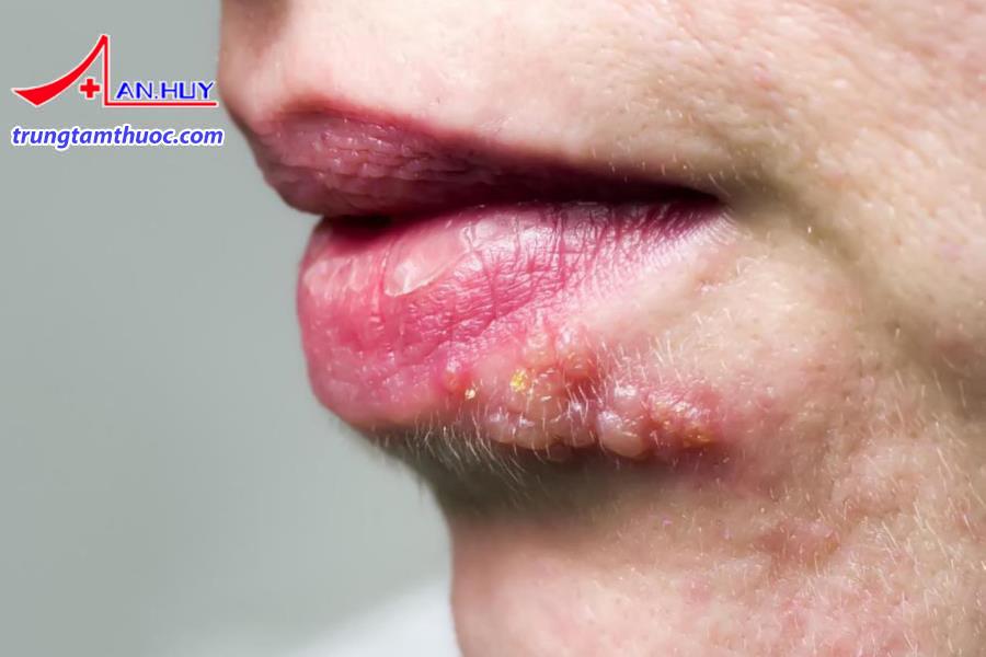 Bệnh zona có những triệu chứng như thế nào?