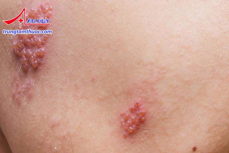 Bệnh zona được điều trị như thế nào?